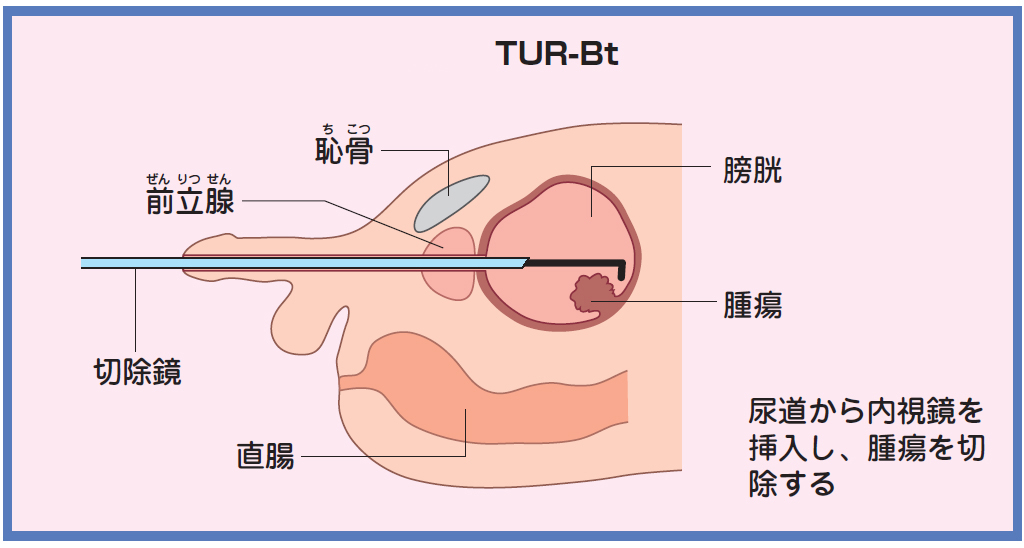 膀胱がんの内視鏡手術の仕組み＝中川恵一氏提供