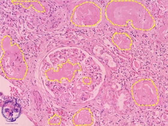 腎アミロイドーシス ミクロ像　糸球体、血管周囲に好酸性の均質な物質（アミロイド）の沈着がみられる（黄色点線）【日本病理学会提供】