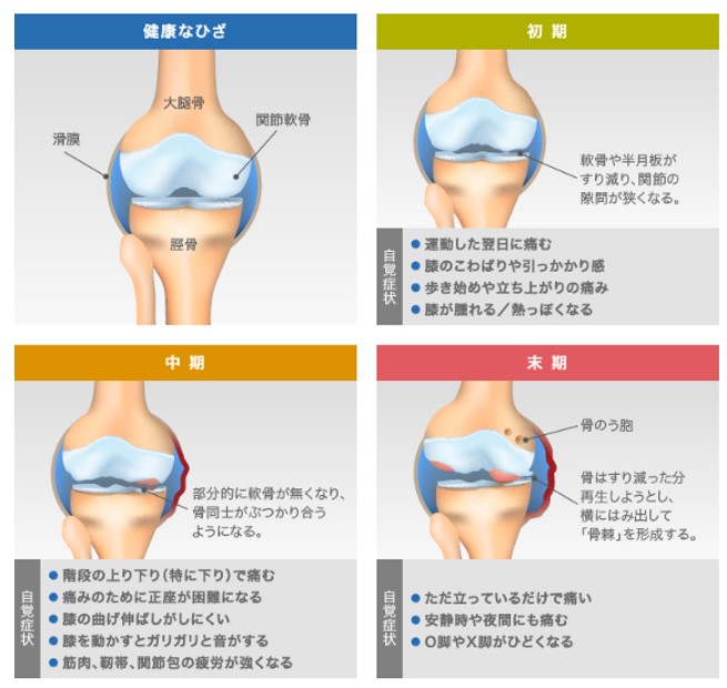 軟骨のすり減りがひどいと立っているだけで痛い(ひざ関節症クリニック作成)