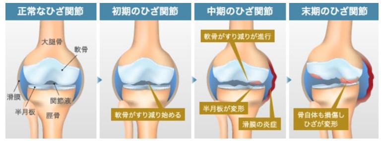 変形性膝関節症は適切に対処しないまま放置すると、どんどん進行していく(ひざ関節症クリニック作成)