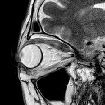 図２ 甲状腺眼症のMRI（右眼の側面像）。この断面では上直筋の腫脹（しゅちょう）が目立っ