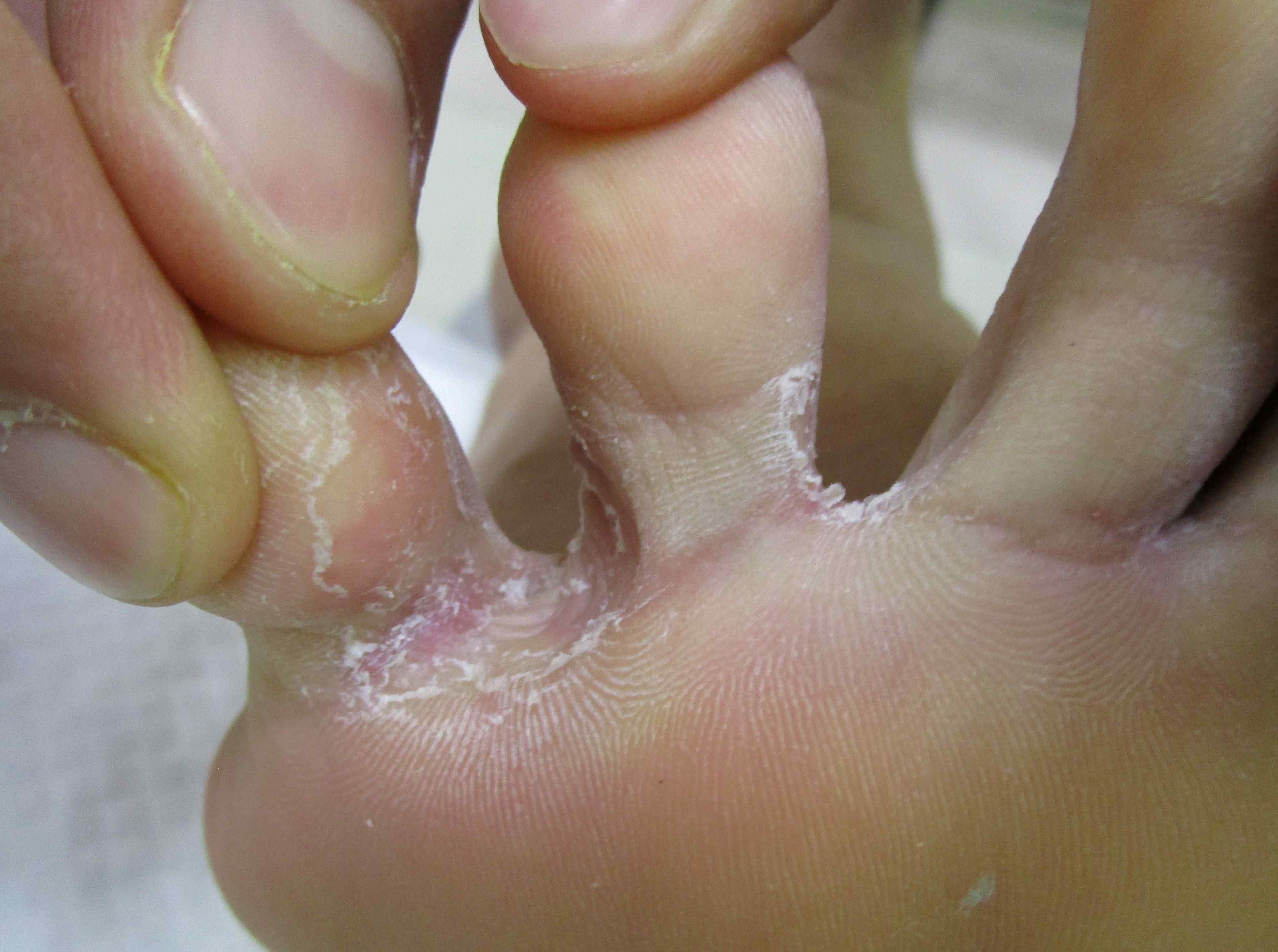 指の間のただれた部分が白癬菌の繁殖エリア
