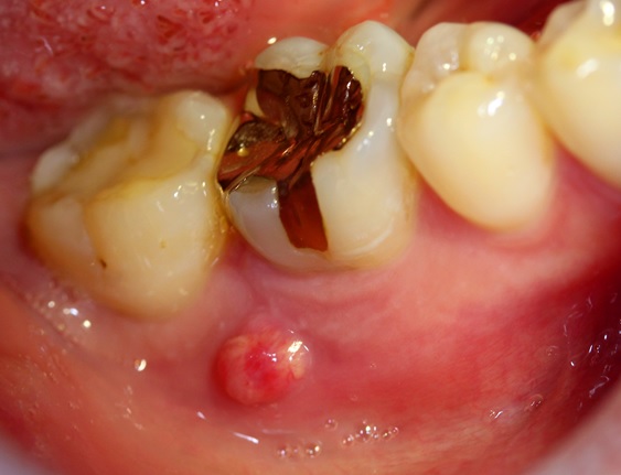 歯茎に現れたおできのような腫れ＝写真3