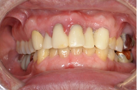 炎症が見られる上の歯茎。前歯との境目が腫れている＝写真1