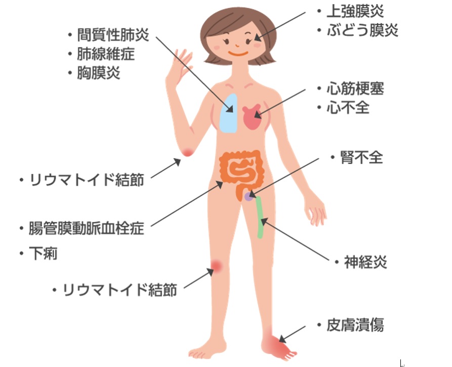 関節以外に起こる可能性がある症状（引用：湯川リウマチ内科クリニック）