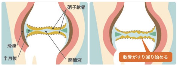 変形性膝関節症は、軟骨がすり減る進行性の疾患(ひざ関節症クリニック作成)