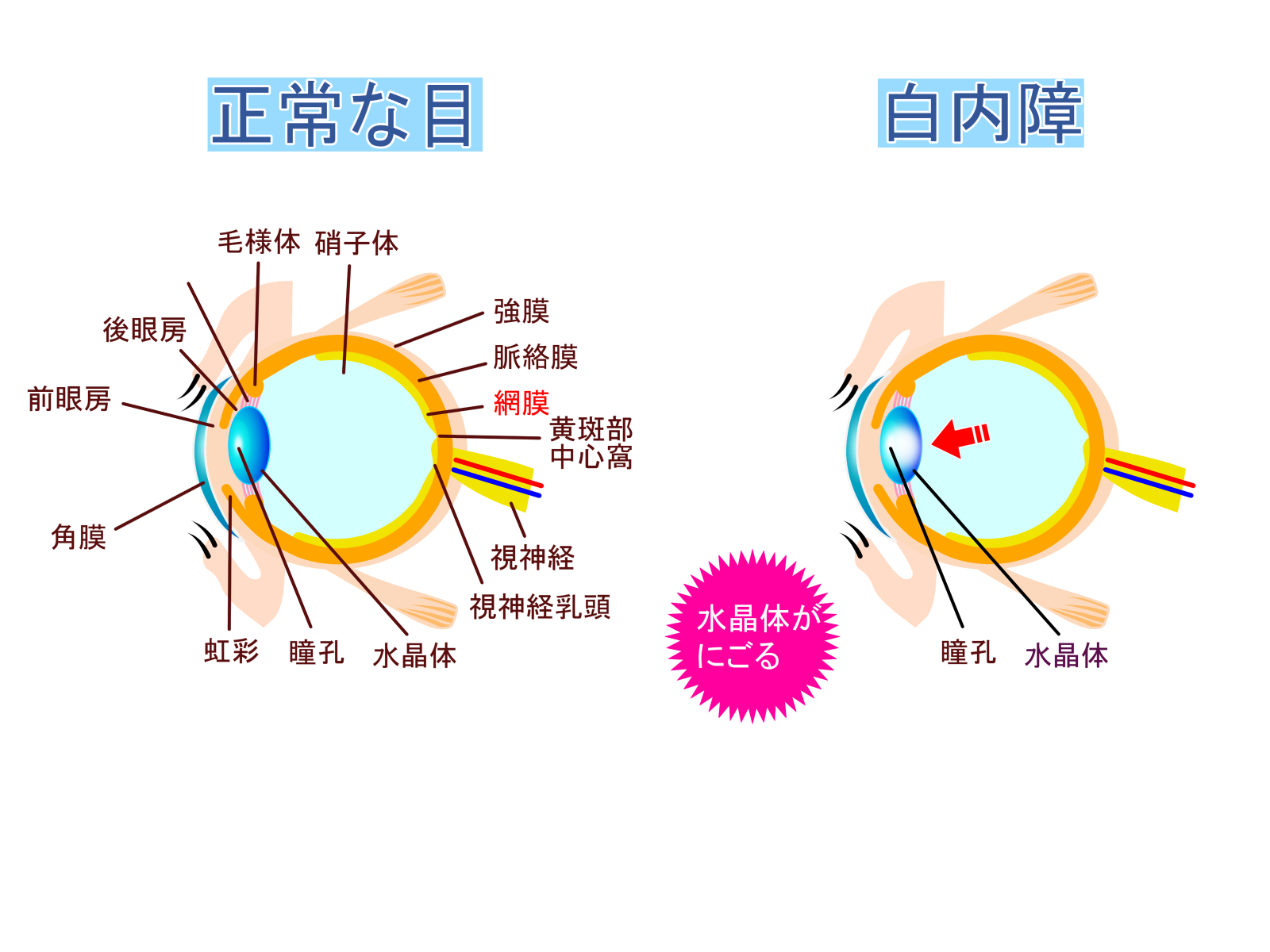 白内障の仕組み