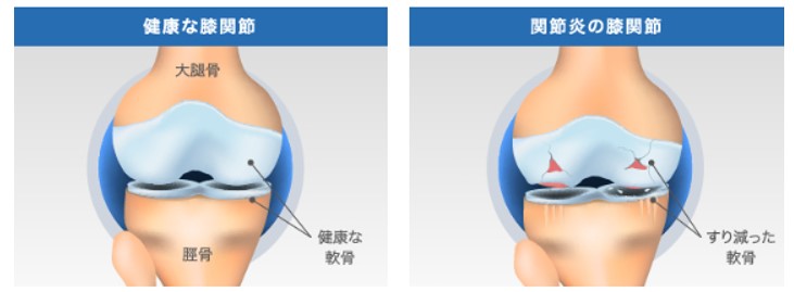 健康な膝関節(左)と関節炎の膝関節(ひざ関節症クリニック作成)