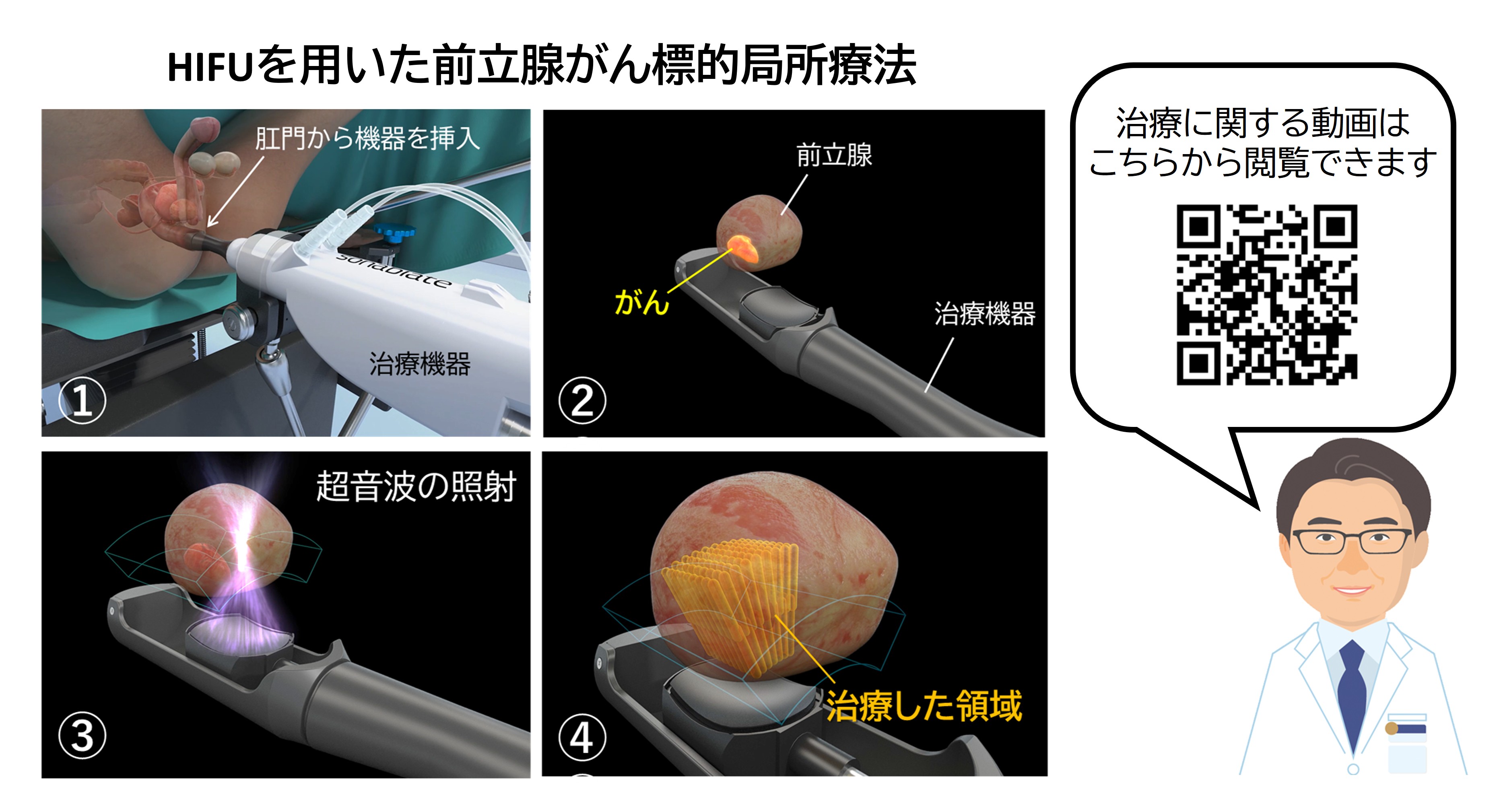 先進医療HIFUの仕組み