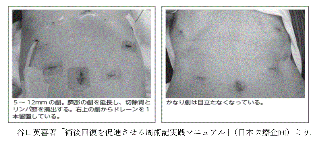胃がんの手術直後（左）と１か月後。１カ月後は傷跡（創）があまり目立たない