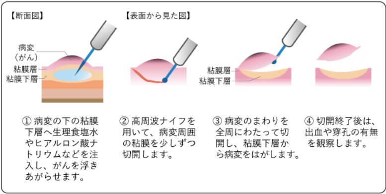 内視鏡的粘膜下層剥離術（国立がん研究センターのホームページより）