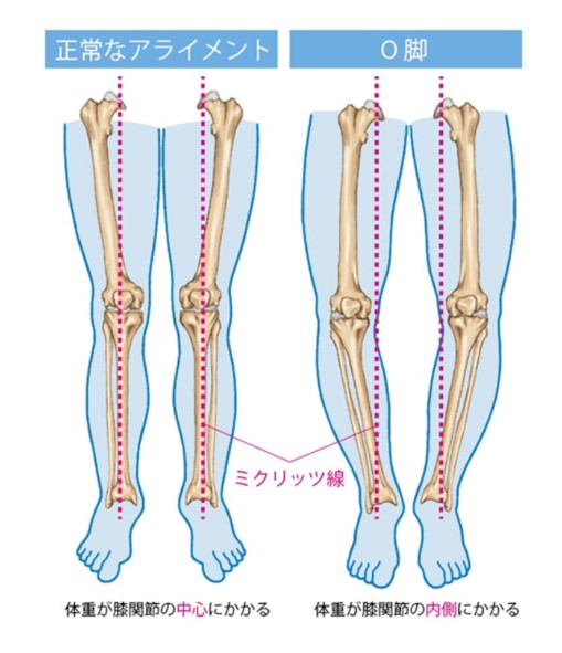 変形性膝関節症の原因にもなり得る危険因子の一つにO脚がある(ひざ関節症クリニック作成)