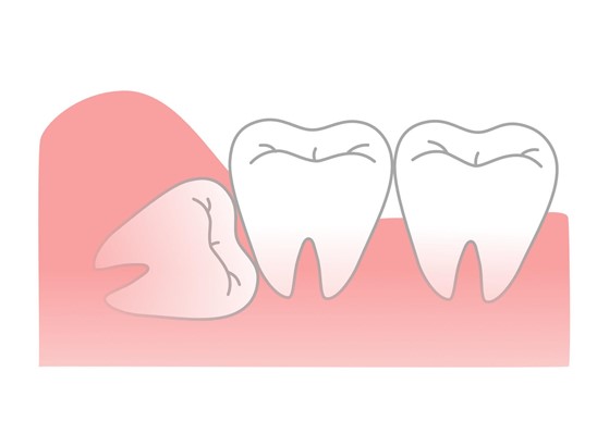 親知らずが完全に歯茎の中に埋まっていても他の歯へ悪影響が懸念される場合は抜歯が必要