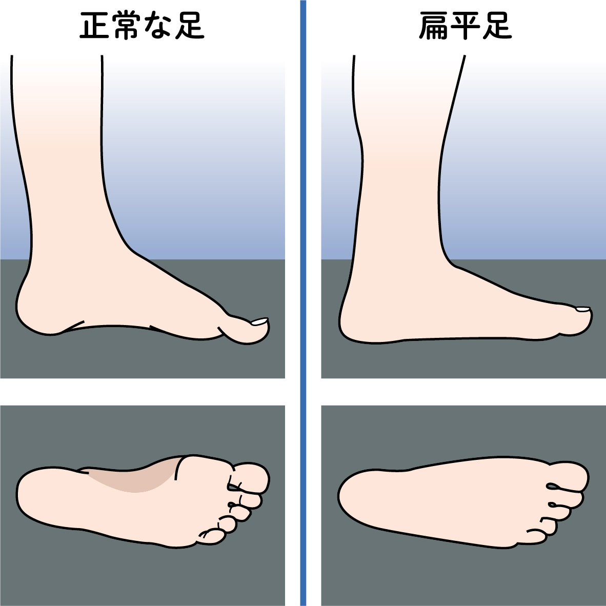 歩行障害のリスクになる扁平足（右）と正常な足