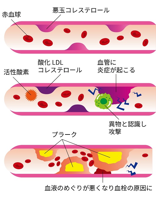 悪玉コレステロールが血液の流れを悪くする