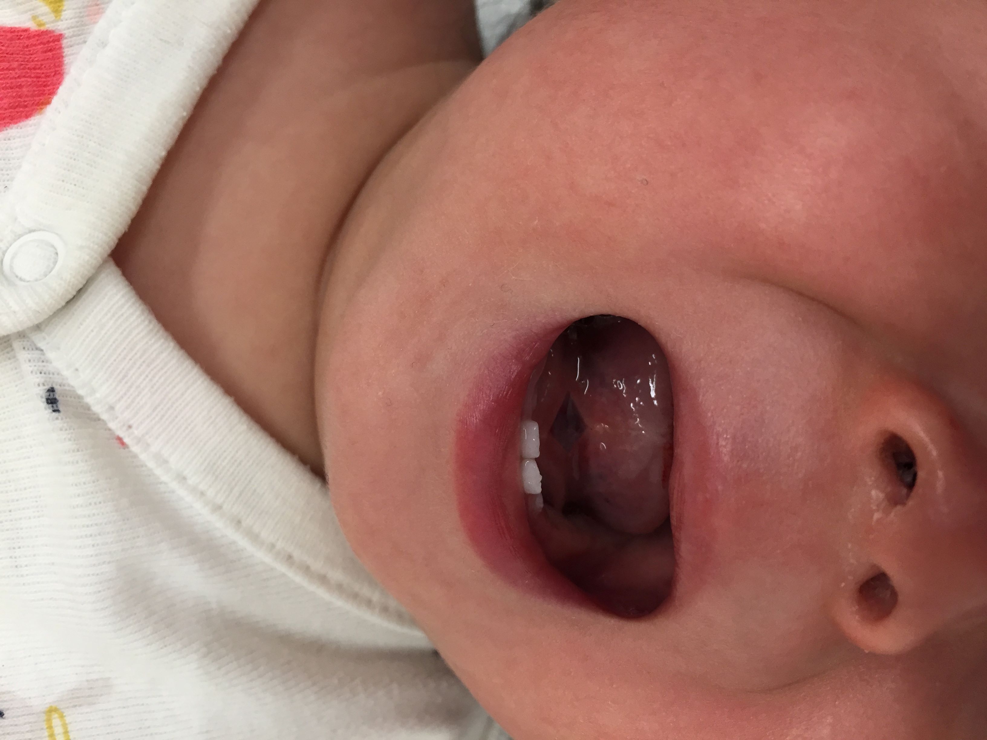 切開手術後、舌が上がるようになった乳児（伊藤泰雄氏提供）