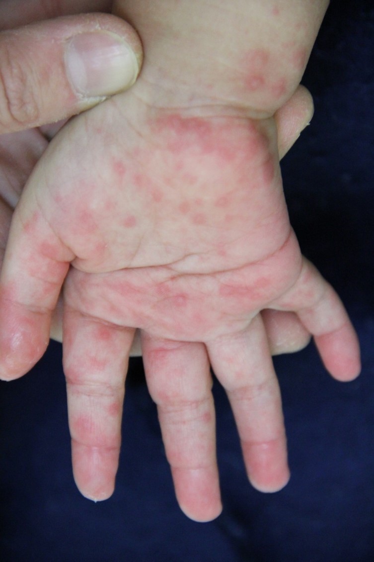 水疱瘡 と 手足 口 病 の 違い
