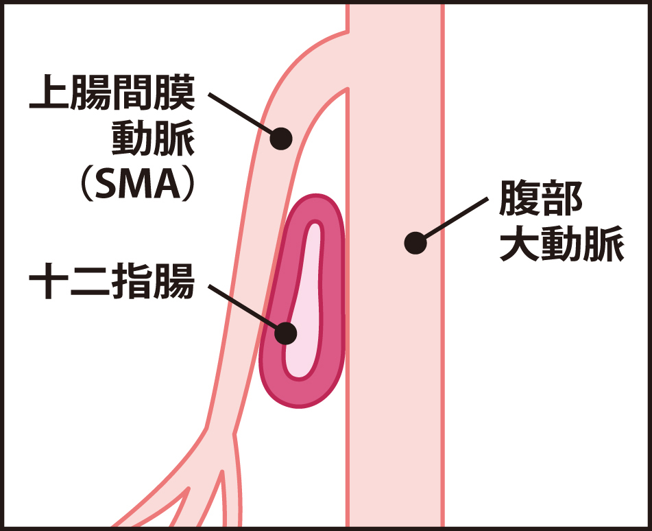 ＳＭＡ症候群（断面のイメージ）