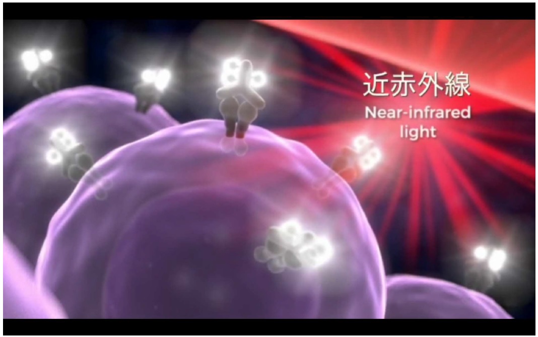 光免疫療法のイメージ図。紫色のがん細胞と結び付いた抗体薬に近赤外光を当てて破壊する（米国立衛生研究所提供）