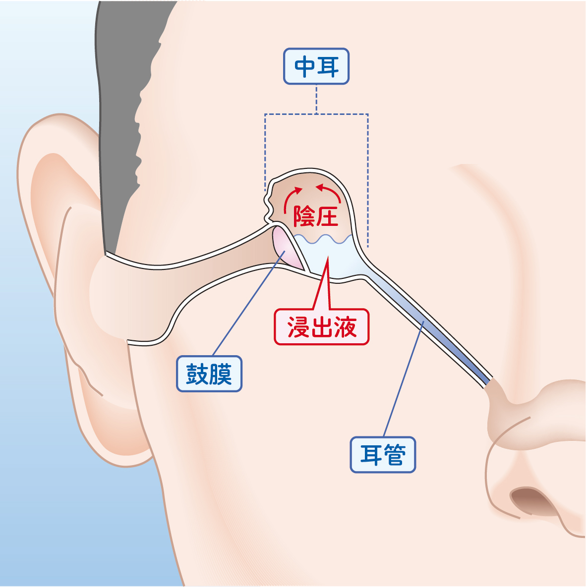 耳管がふさがり、中耳に滲出液がたまる
