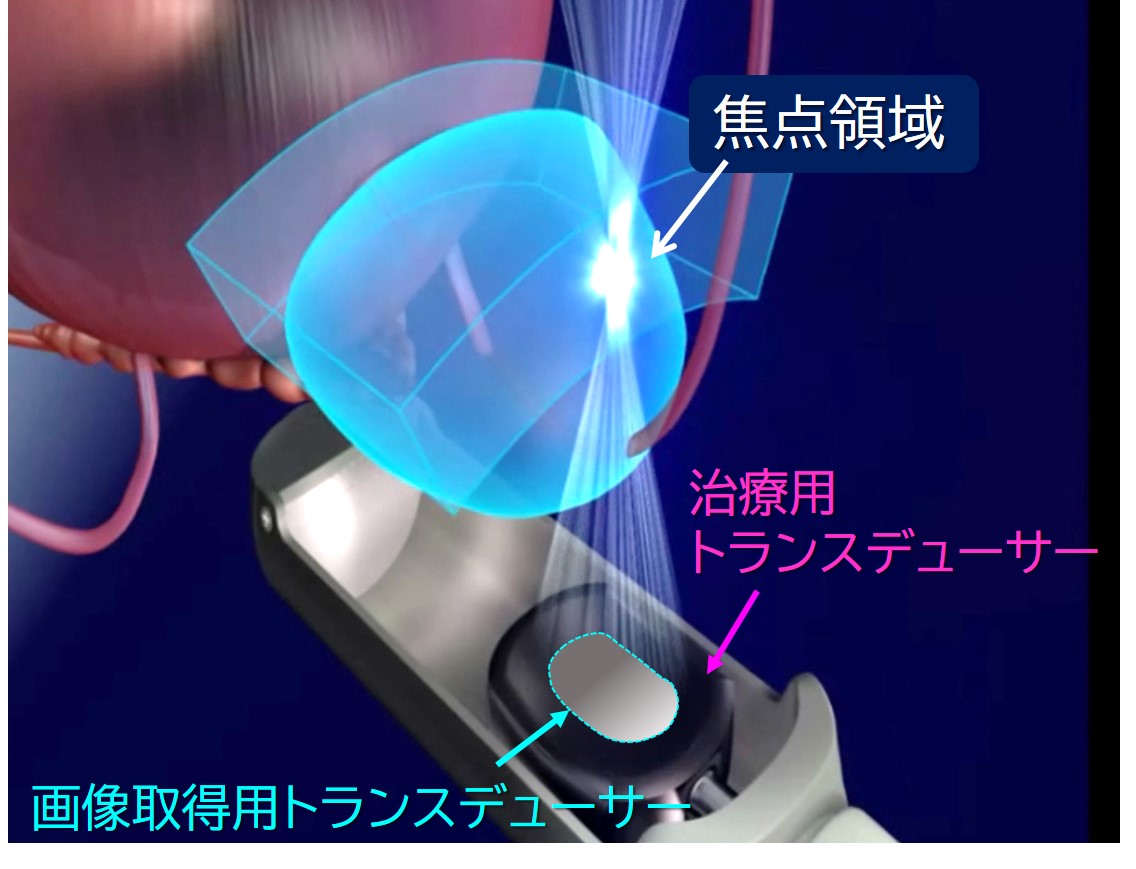 高密度焦点式超音波療法のイメージ