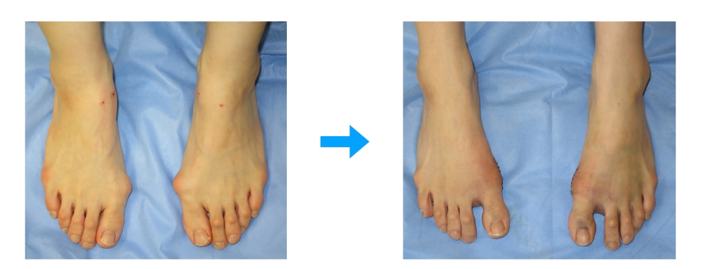 外反母趾の（左から）手術前と手術後