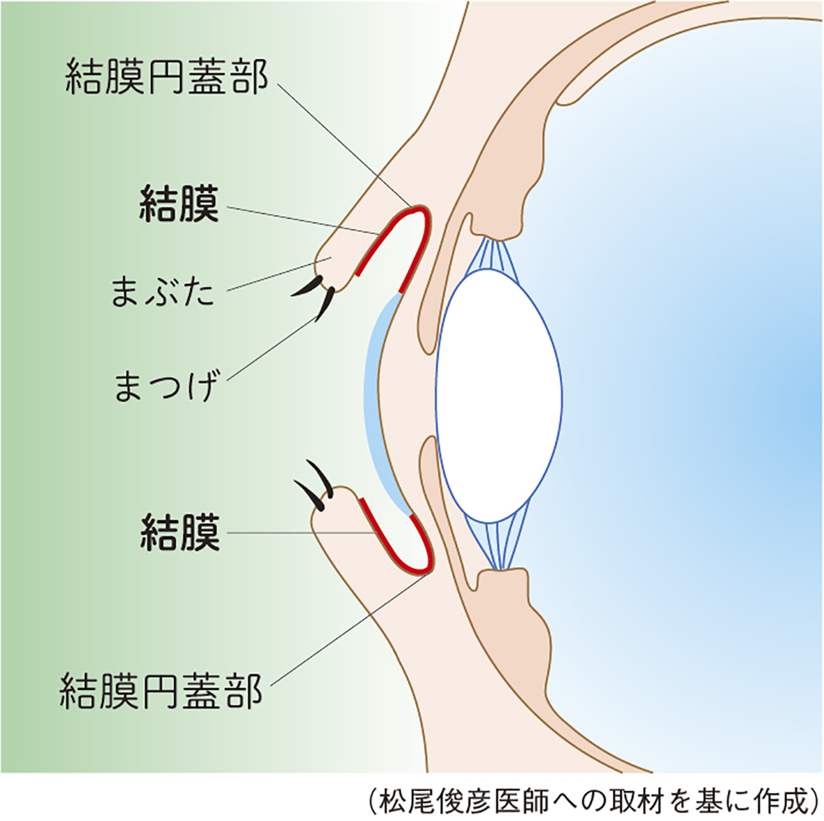 結膜リンパ腫は結膜円蓋部が赤みのあるピンク色に腫れる