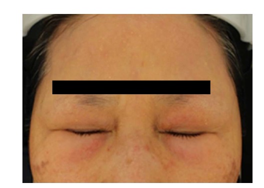 額と目の周りに、花粉による皮膚炎が＝野村医師提供