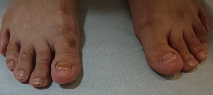 巻き爪、爪甲肥厚、重複爪の治療を終えた患者さんの足指。しかし、このまま放置すると、また同じような爪が生えてくる可能性がある