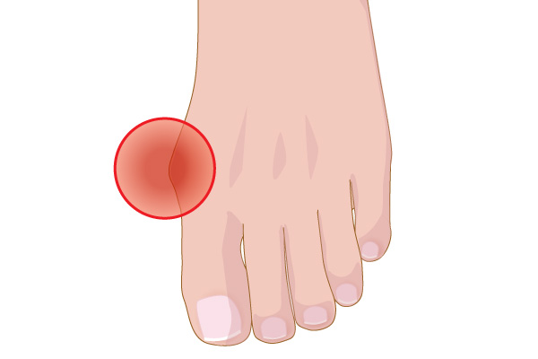 強剛母趾では親指の付け根が痛むため、痛風の症状と誤解する人も多い【時事通信社】