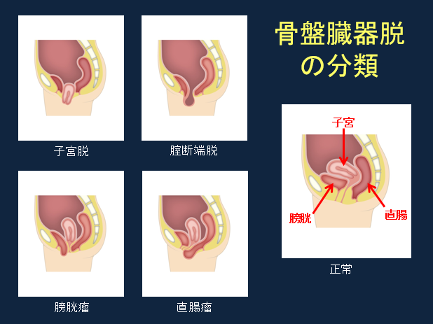 骨盤臓器脱の分類