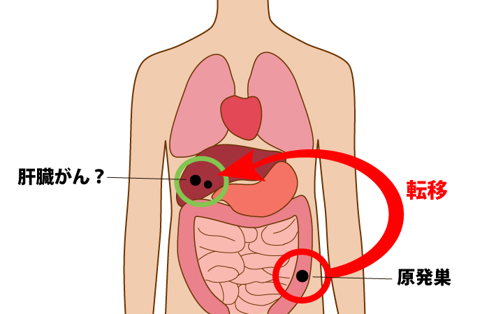 がんの「転移」を知ろう
