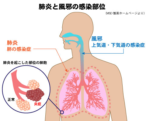 肺炎と風邪の感染部位