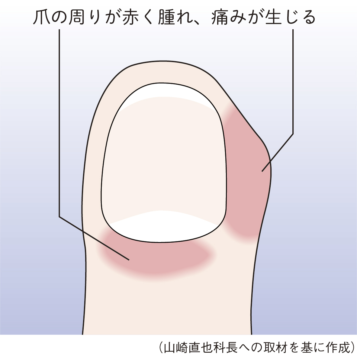 爪囲炎の初期は爪の周囲が赤く腫れ、痛む