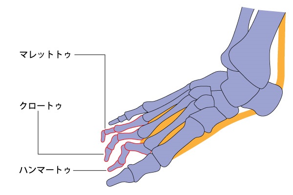 足関節の変形