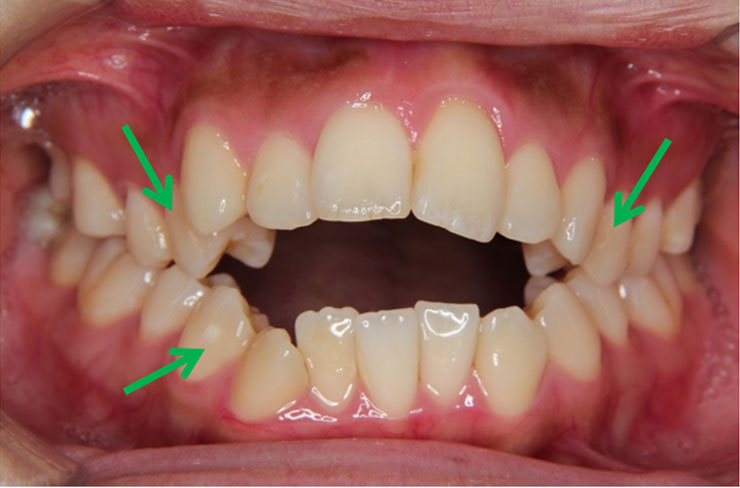 上下の歯の間に隙間。３本を抜歯し治療