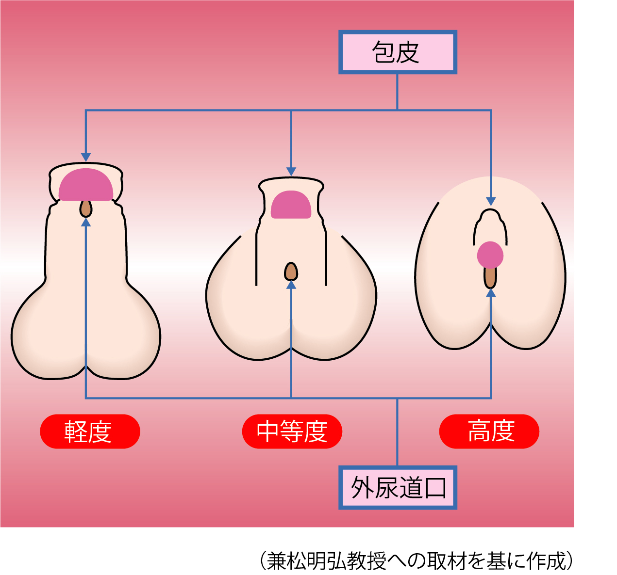 尿道下裂の形態。外尿道口が会陰部に近いほど重症