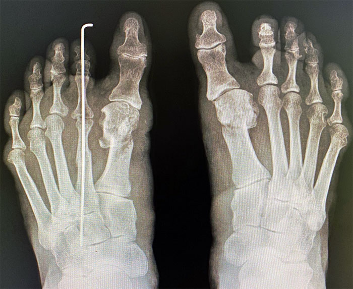 手術後の足のレントゲン写真。左足の人差し指には変形を矯正するために針金が通されている（「足のクリニック表参道」提供）
