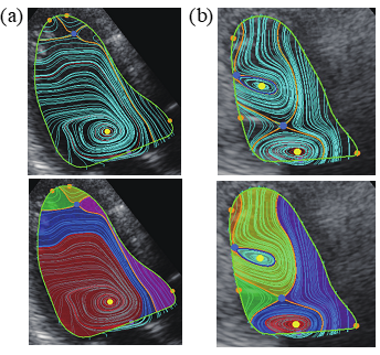 図2（a）健常な心臓の心エコーVFMデータ とTFD解析で得られた渦流領域（赤） (b) 心不全患者の心臓の心エコーVFMデータとTFD解析で得られた渦流領域（赤と水色）