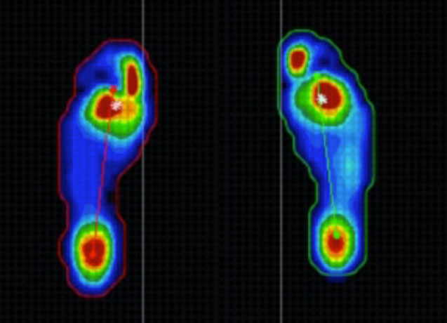 足底圧測定装置で撮影した扁平足の歩行の様子（「足のクリニック表参道」提供）
