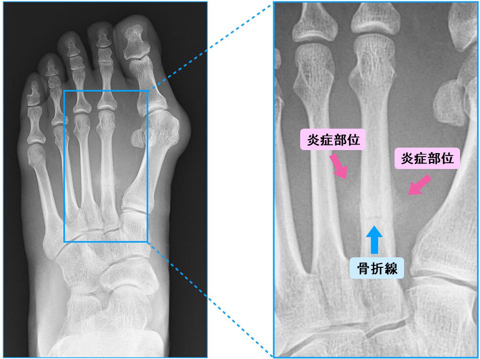 疲労骨折のレントゲン画像。受傷から２週間後の状況で、右側は骨折部位を拡大画像。中指の基部に亀裂（骨折線）が見える。（「足のクリニック表参道」提供）