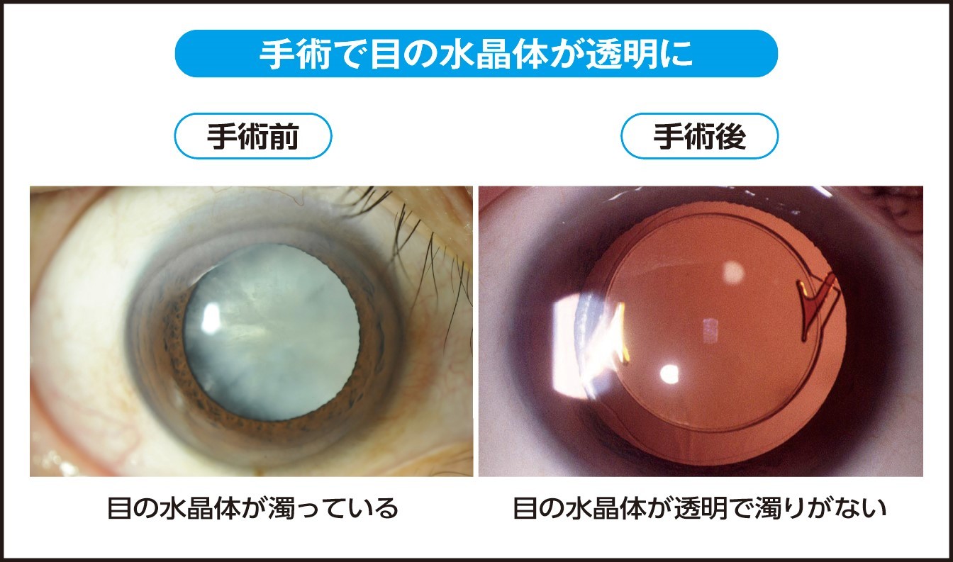 手術で目の水晶体が透明に