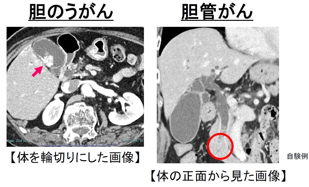 造影ＣＴによる胆道がんの画像＝アストラゼネカ胆道がんメディアセミナー資料より