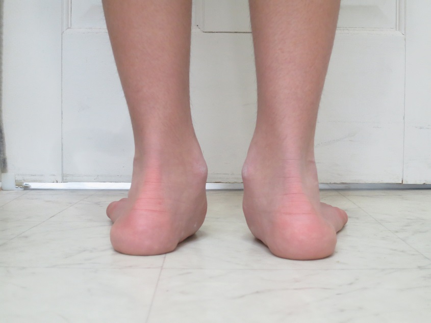 第11回 「Ｏ脚だから」と諦めないで！～治療・改善法はあります～｜足の悩み、一挙解決｜時事メディカル｜時事通信の医療ニュースサイト