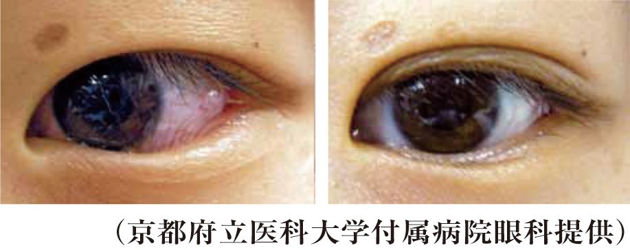 睫毛内反症の術前（左）と術後（右）