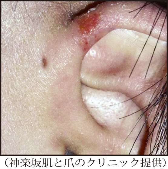 耳の周辺に小さな穴ができる耳瘻孔（耳の上部。炎症を起こして赤く腫れている）