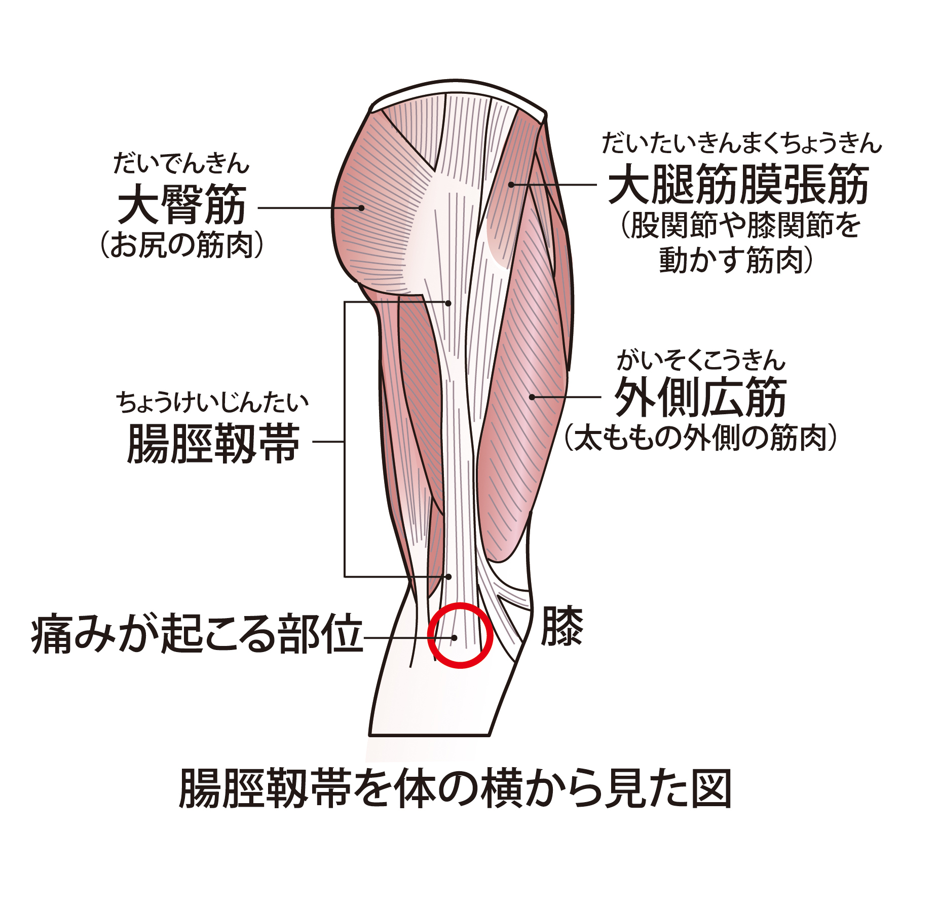 ランナー膝とも呼ばれる腸脛靭帯炎