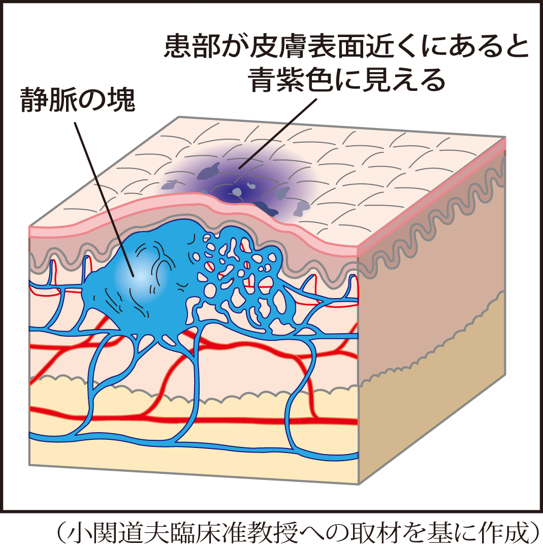 皮膚の下などに静脈の塊ができる