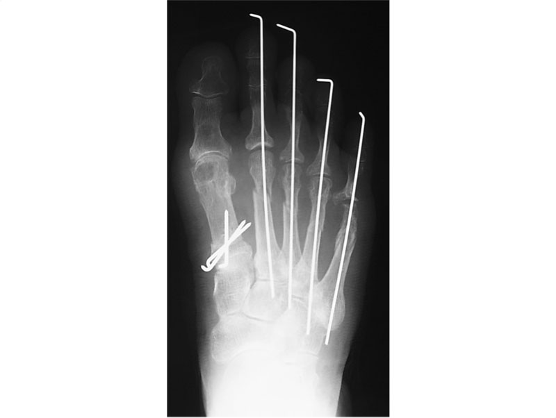 針金で足指を一時的に固定した状態のレントゲン写真（「足のクリニック表参道」提供）