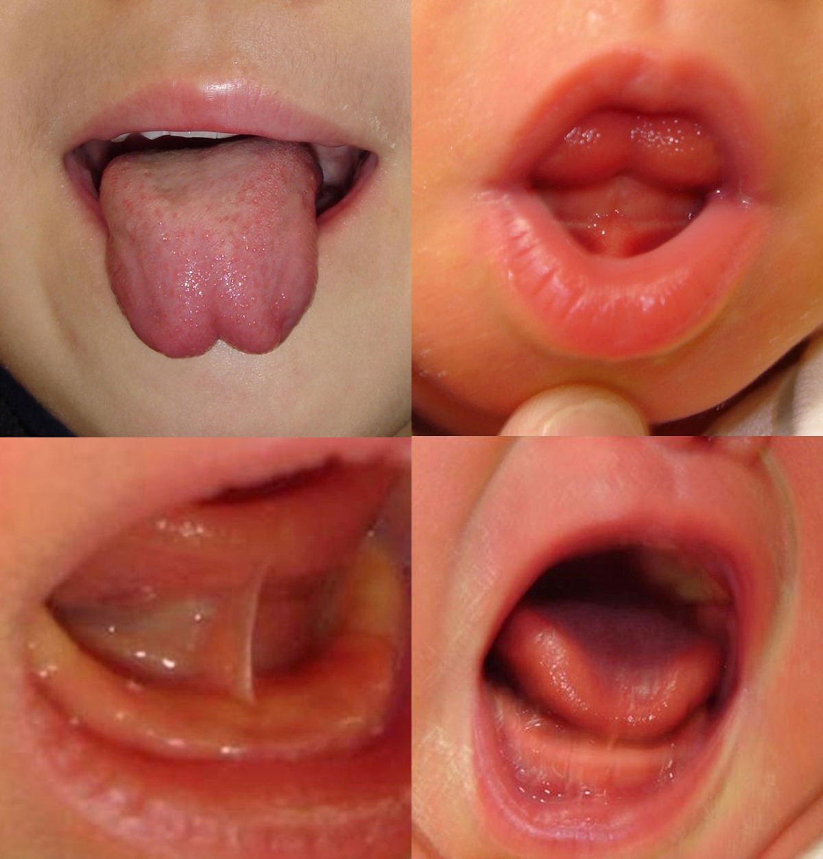 舌小帯短縮症の子どもの舌の様子（新百合ヶ丘総合病院提供）